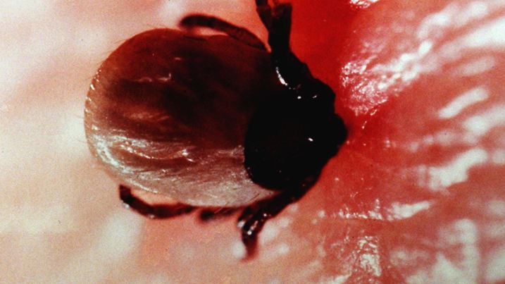 Ein Zeckenweibchen auf einer Makroaufnahme beim Saugen in der menschlichen Haut (undatiertes Archivbild). Experten raten zur Impfung gegen die kleinen Vampire. Ihre Stiche sind im allgemeinen harmlos, einige Zecken übertragen jedoch Krankheitserreger, die Hirnhautentzündung (Frühsommer-Meningoenzephalitis)  oder das sogenannte Rückfallfieber (Lyme-Borreliose) auslösen können. dpa (Zu dpa Korr.-Bericht "Experten raten zur Impfung..." vom 02.04.2001)