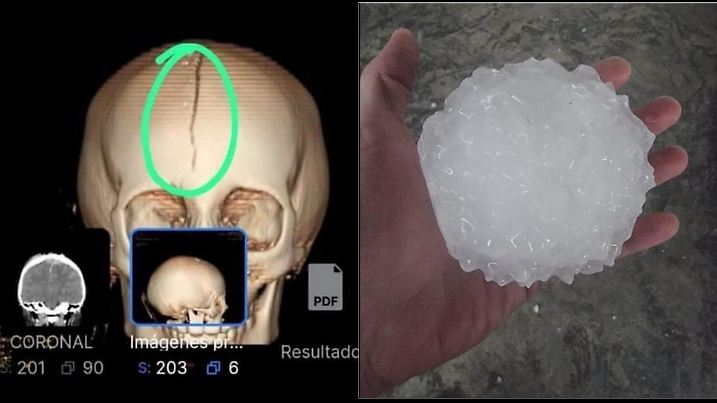 Ein riesiges Hagelkorn führte bei einem 8-Jährigen Mädchen in Mexiko zu einer gebrochenen Schädeldecke.