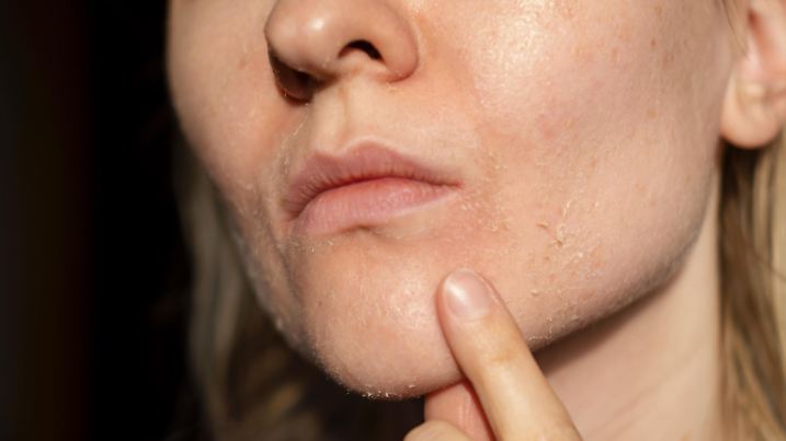 The woman skin flakes off at the mouth. Dry skin. Face skin irritation after peeling, after cold windy weather. Dark background, view by profile. She is showing the problem with the finger.